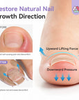 Ingrown Toenail Corrector Kit (Ships to US Only)