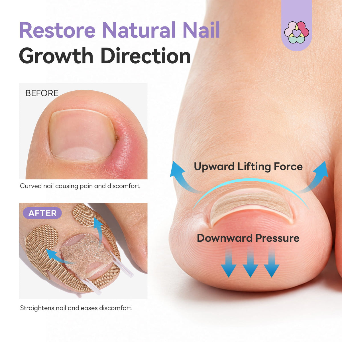 Ingrown Toenail Corrector Kit (Ships to US Only)