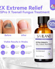 Advanced Toenail Fungus Treatment for Damaged Nails